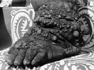 L'horreur d'un pied infecté par l'éléphantiasis
